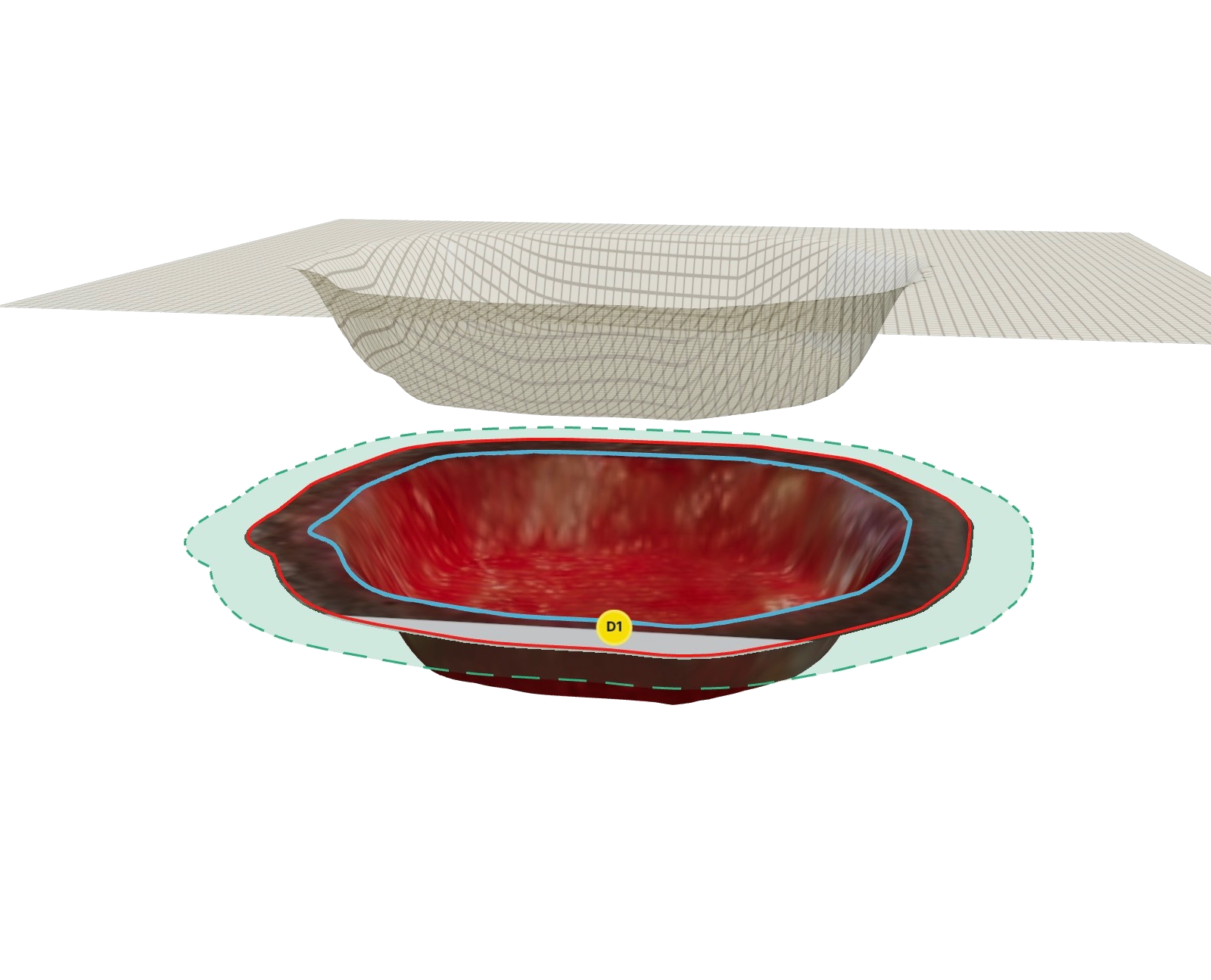 3D reconstruction of a wound bed with a surface mesh above it and traced wound and margin outlines below